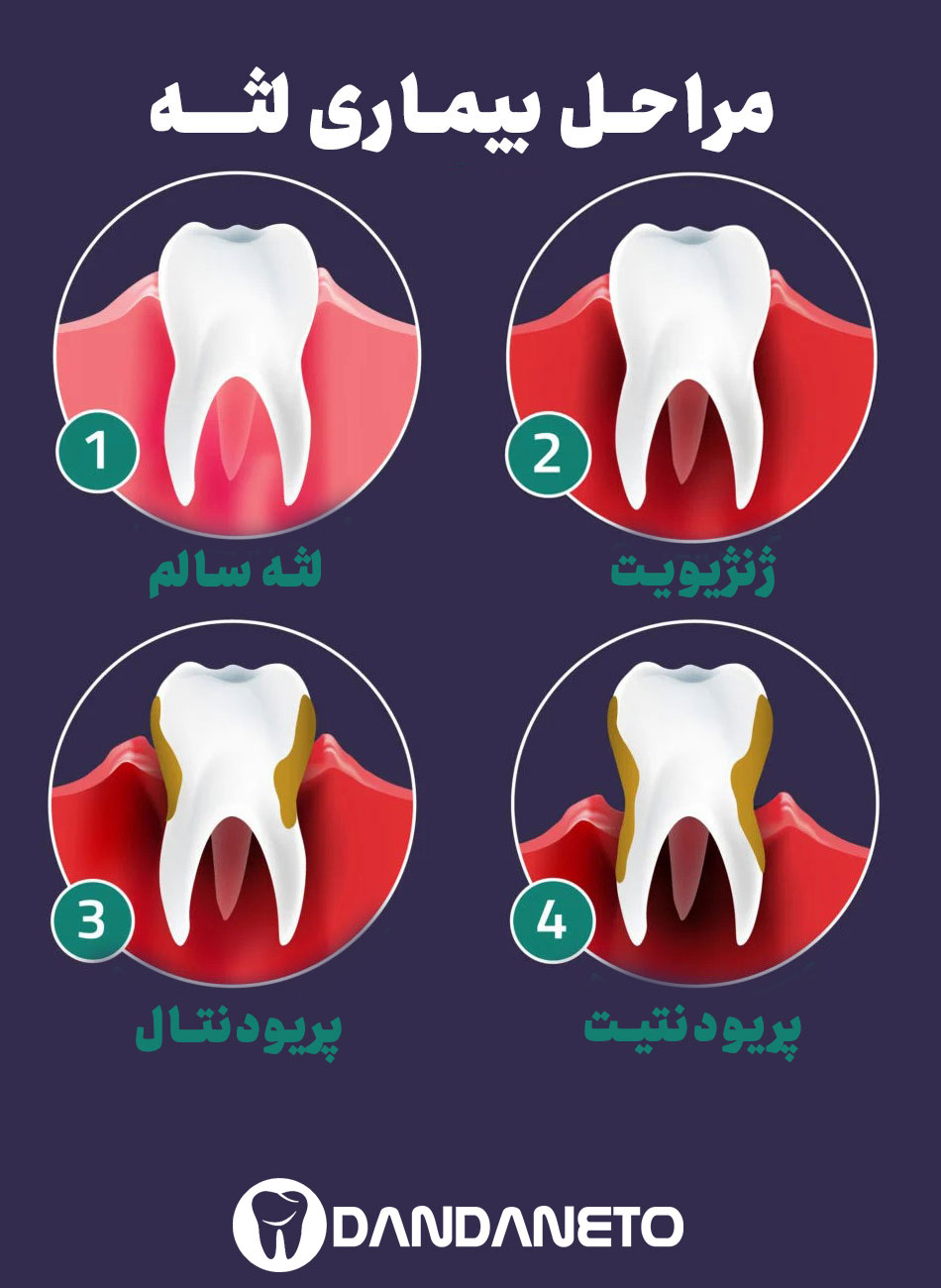 اینفوگرافیک بیماری لثه