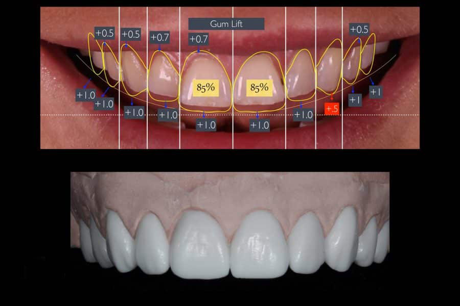 مراحل طراحی لبخند دیجیتال